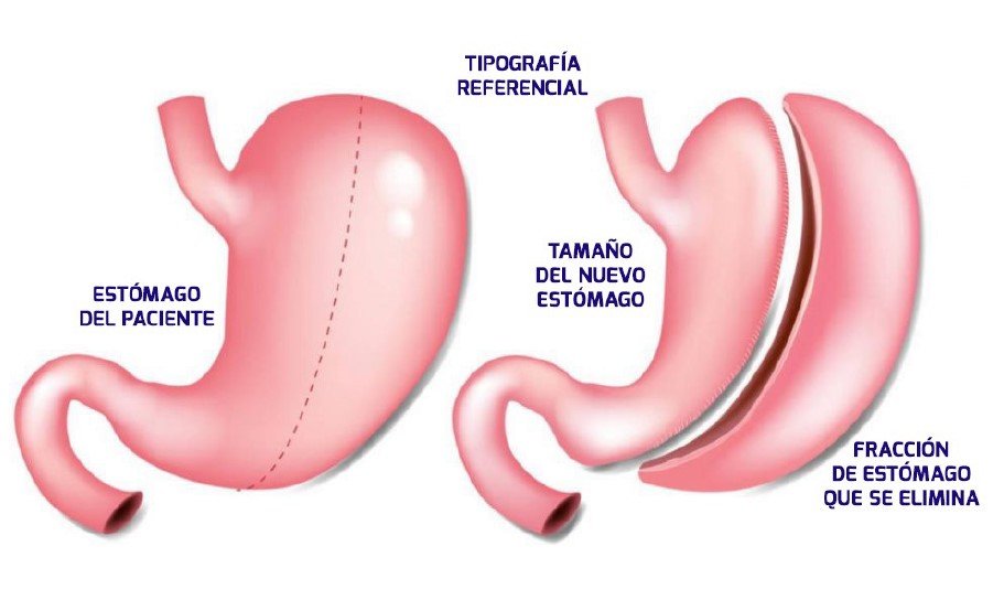 tipografia referencial manga gastrica
